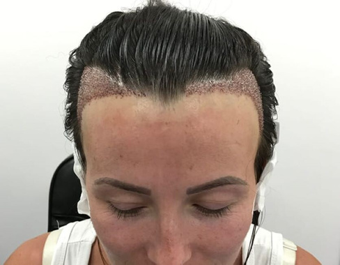 Минимальная пересадка волос на голову для женщин